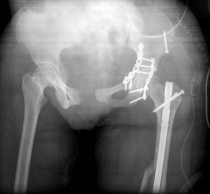 X-ray of patient's fractured femur in Haiti (after treatment)