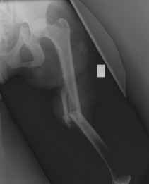 X-ray of patient's fractured femur in Haiti (before treatment)