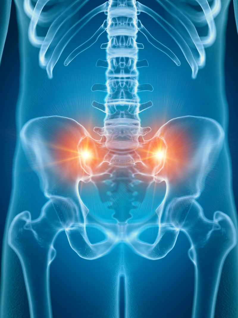 Sacroiliac Joint Dysfunction Archives - Posture Phyx